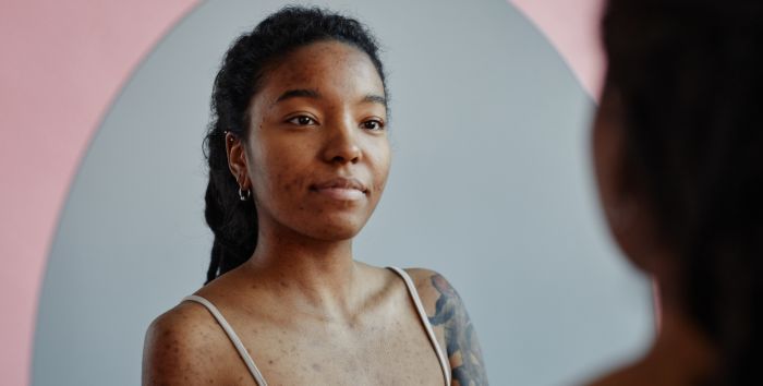 Miniature article acne